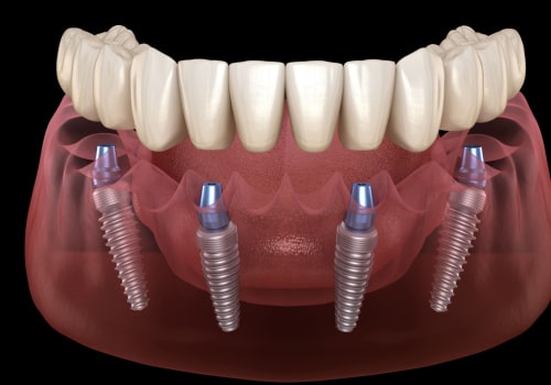 How All-On-Four Dentures With Dental Implants Can Transform Your Smile In London