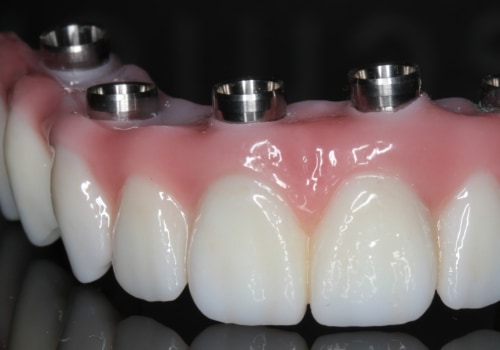 Do I Need to See a Dentist Regularly if I Have All on Four Dentures?