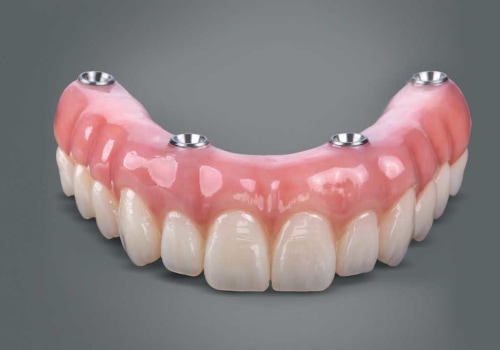 How Long Does All-on-4 Denture Last?