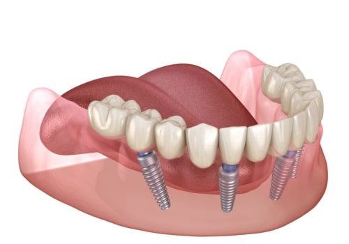Can I Speak Normally with All-On-Four Dentures?
