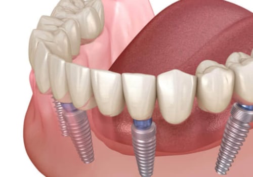 Will All-on-Four Dentures Feel Natural in Place?