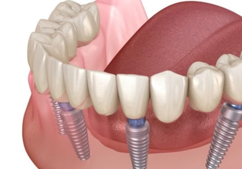 Recovering from All-on-Four Dental Implants: How Long Does It Take?