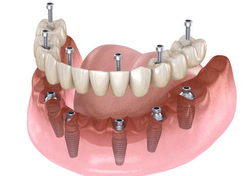 Making The Right Choice: How To Find The Best Dentist For All-On-Four Dentures In Monroe