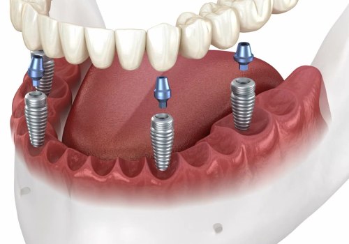 All-on-Four Dentures And Veneers In Round Rock: How They Can Transform Your Smile And Boost Your Confidence