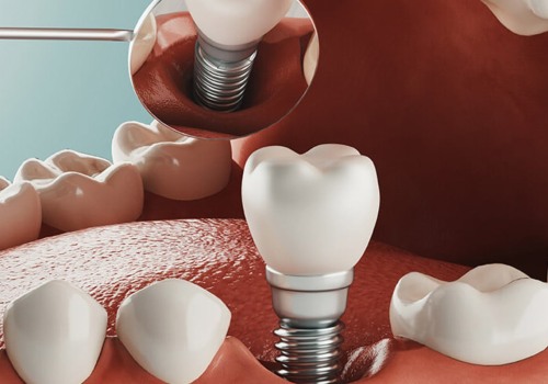 Exploring Alternatives to All-on-Four Dental Implants