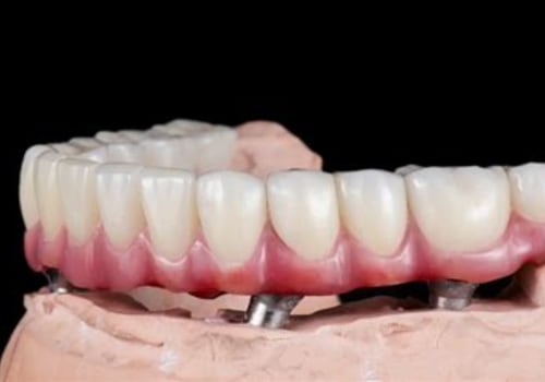 The Hidden Challenges of Adapting to Full-Arch Implant-Supported Dentures