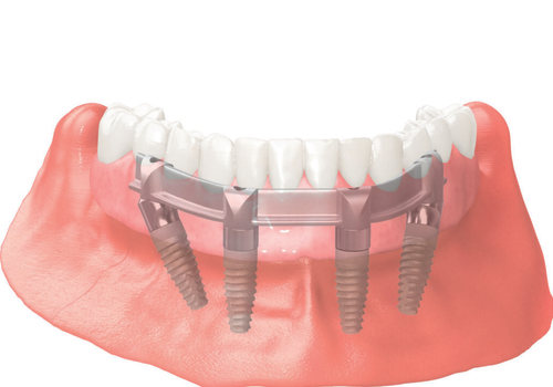 A Perfect Solution For Missing Teeth In Austin, TX: Benefits Of All-On-Four Dentures