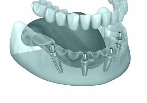 The Role Of Children’s Emergency Dentists In Basel With All-on-four Dentures