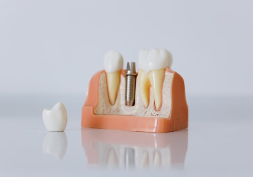 Revolutionizing Tooth Replacement: Mcgregor's All-on-four Dentures And Dental Implants