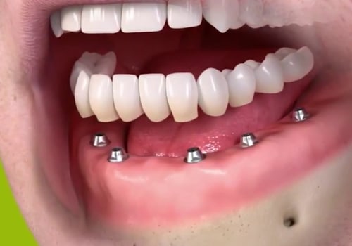 Will My Gums Be Visible When I Wear My All-on-Four Dentures in Place?