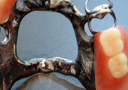 What is the Most Expensive Type of Denture?