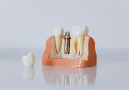 Revolutionize Your Smile: All-on-four Dentures In Helotes, TX - A Comprehensive Guide To Dental Services