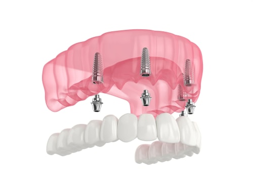 All-On-4 Dental Implants Vs. All-On-4 Dentures: Which Is Right For You In Honolulu