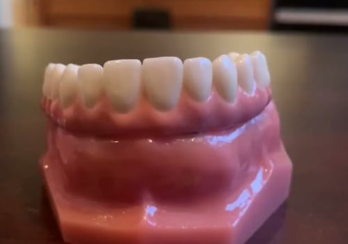 What are All-on-Four Dental Implants?