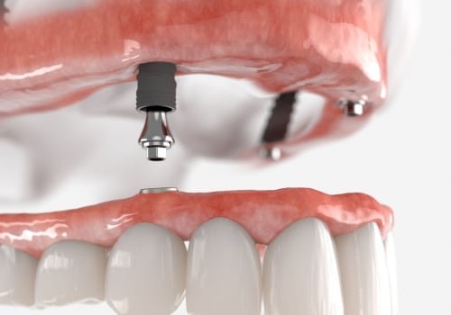 What is the Difference Between Snap-in Dentures and All-on-4 Implants?