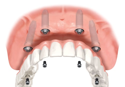 Transforming Smiles In Pflugerville, TX: How Invisalign Works Together With All-On-Four Dentures For Optimal Results